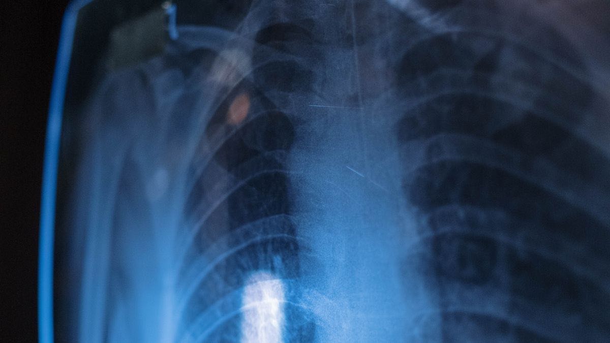 A chest X-ray film held against the light — X-ray search seeing through to public LinkedIn profiles